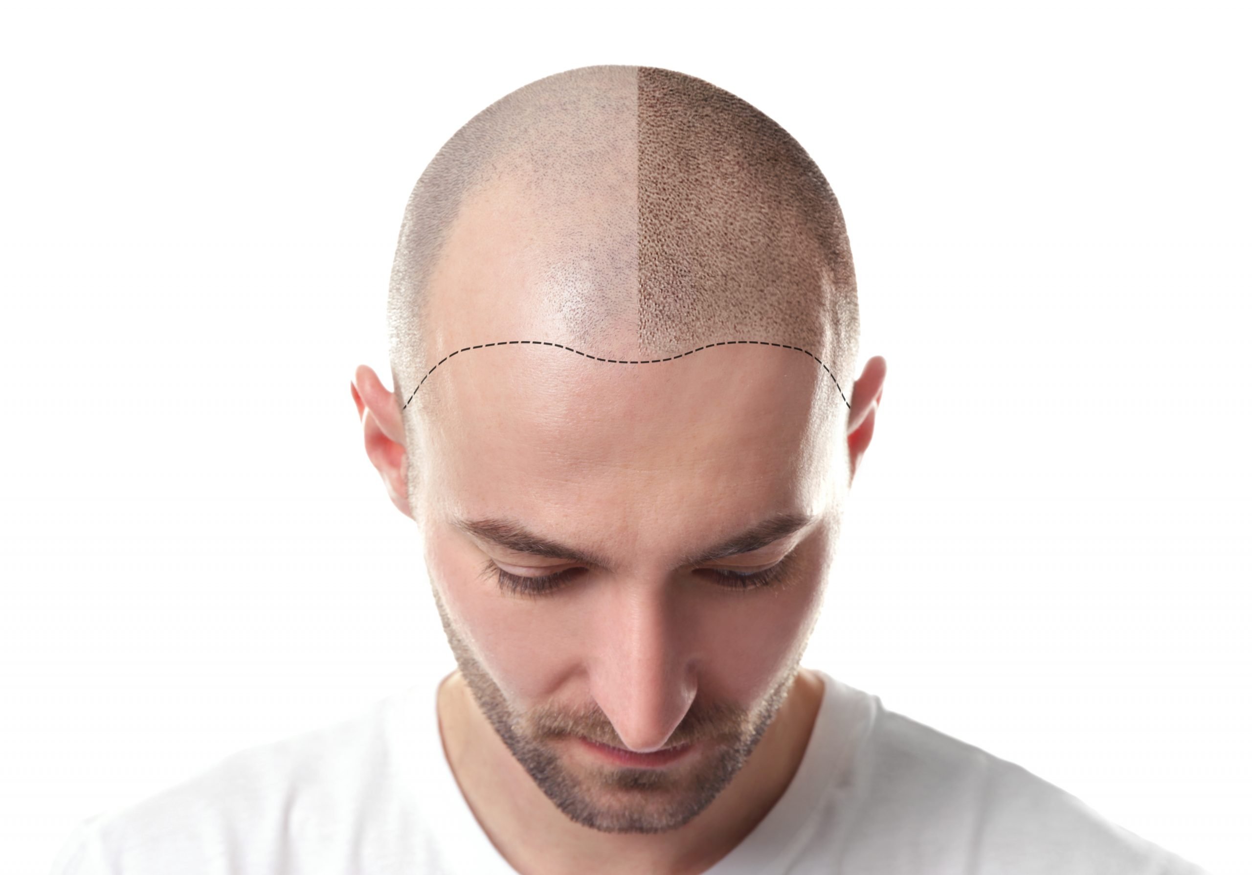 Hair Loss Treatment